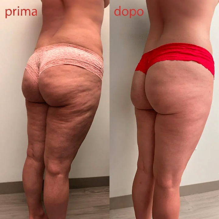 Evored™ Body Sculpting – Il Segreto per una Silhouette Definita
