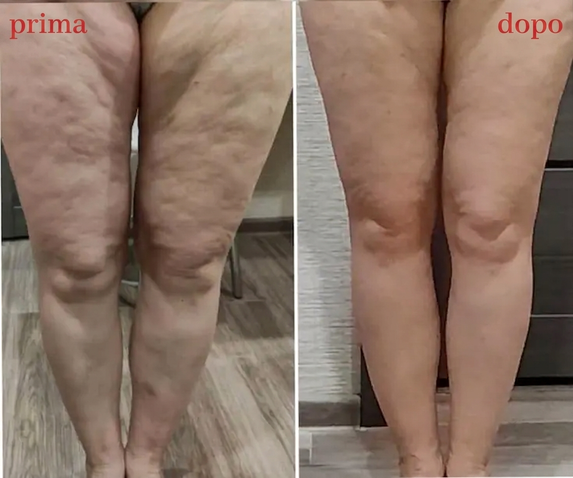 Evored™ Body Sculpting – Il Segreto per una Silhouette Definita