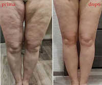 Evored™ Body Sculpting – Il Segreto per una Silhouette Definita